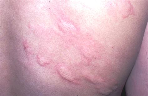 A Skin Rash After Eating Fresh Fruit Allergies Or Chemicals In The