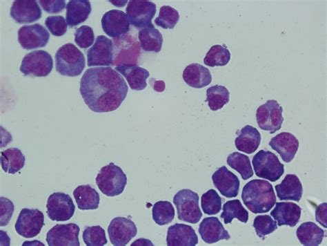 Plasmacytoid Lymphocyte 2 Era