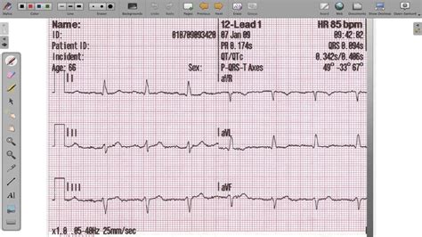 Maybe you would like to learn more about one of these? ECG 12 Lead Axis Deviation - YouTube