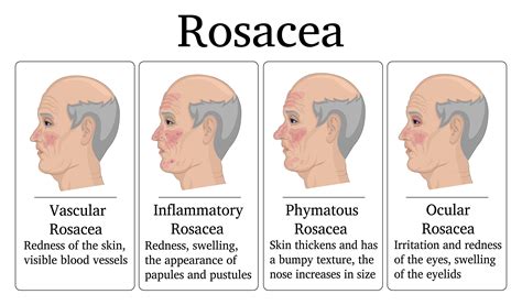Best Essential Oil And Recipes For Rosacea Skin Essential Oil