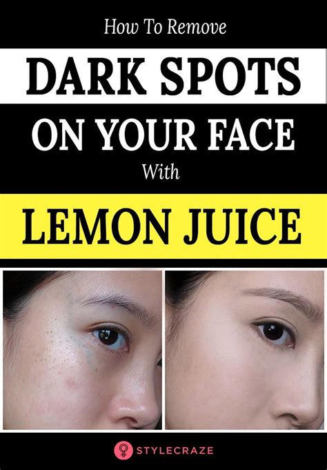 How To Remove Dark Spots On Your Face With Lemon Juice You Might Have