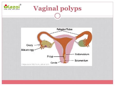 Ppt Vaginal Polyps Causes Symptoms Diagnosis And Treatment