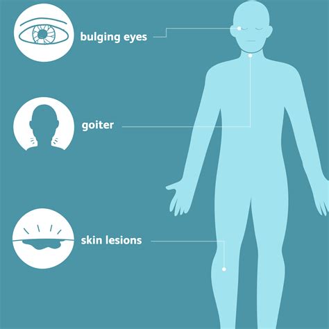 Graves Disease Symptoms Causes Diagnosis Treatment