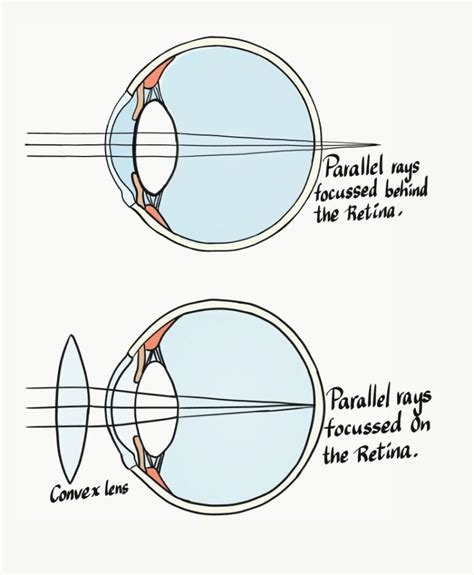 A Complete Overview Of Hypermetropia Farsightedness Medrenaline