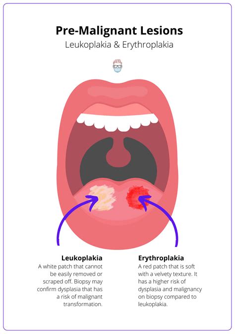 Erythroplakia Floor Of Mouth