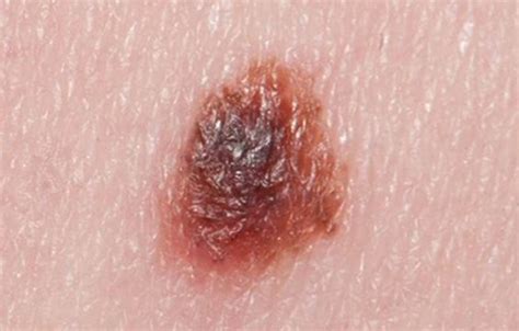 New Moles In Middle Age People Melanoma Or Benign Scary Symptoms