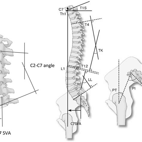 Preoperative Total Spinal Sagittal Alignment Download Scientific Diagram