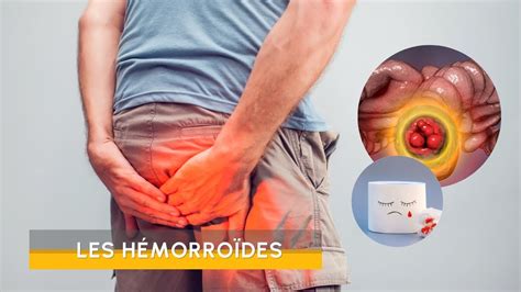 Les hémorroïdes pathologie hémorroïdaire Turquie Santé YouTube