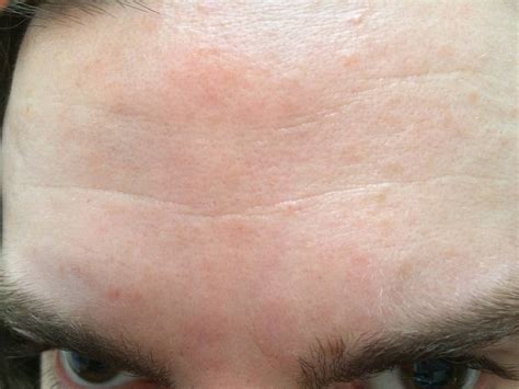 Skin Concerns Itchy Inflamed Bumps And Patches On Forehead