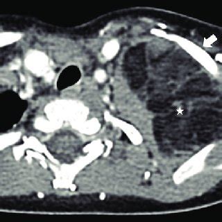 Contrast Enhanced Computed Tomography Axial Section Of Thorax At The Download Scientific