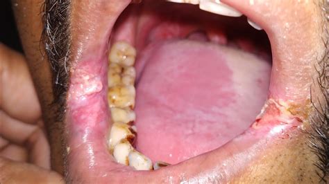 Leukoplakia Signs And Symptoms Youtube