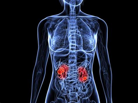 Understanding The Spread Metastatic Renal Cell Carcinoma