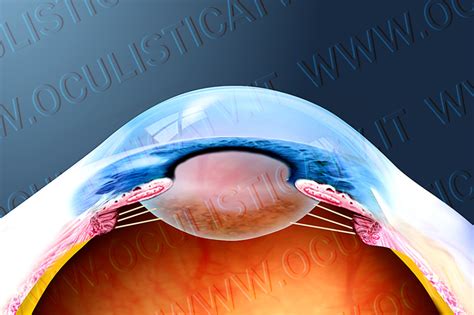 CATARATTA DA CORTISONE - OCULISTICATV