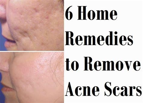 • permanently cure your you have very severe acne • faster than you ever thought possible! Pin on Home remedadies, Back to old tried & true cleaning ...