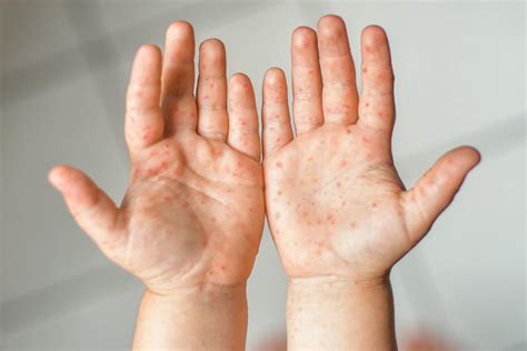 Hand Foot And Mouth Disease In Adults And Kids Get The Facts