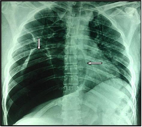 A Rare Case Of Vanishing Lung Syndrome Saj Case Reports Scholarena My