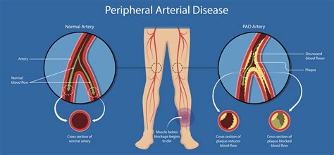 Peripheral Artery Disease Acute Pain In Chest And Leg Are Signs Of Pad My XXX Hot Girl