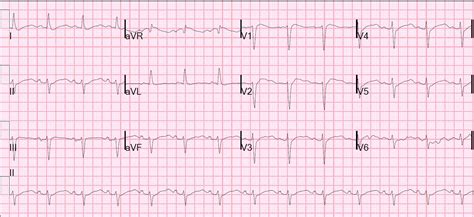 Dr Smiths Ecg Blog What Is The Diagnosis A Nearly