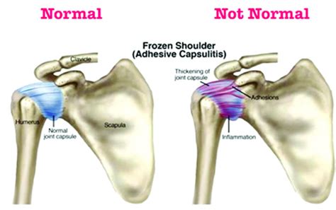Damage to the joint may result from repetitive movements, manual labor, sports, or aging. KRV- Neck and Shoulder Pain Treatment in India | Shoulder ...