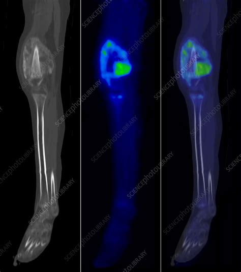 Bone Cancer Of The Leg Ct And Pet Scan Stock Image C0518593