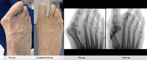 Keyhole Bunion Surgery Perth Dr Andrew Knox Perth Podiatric Surgery