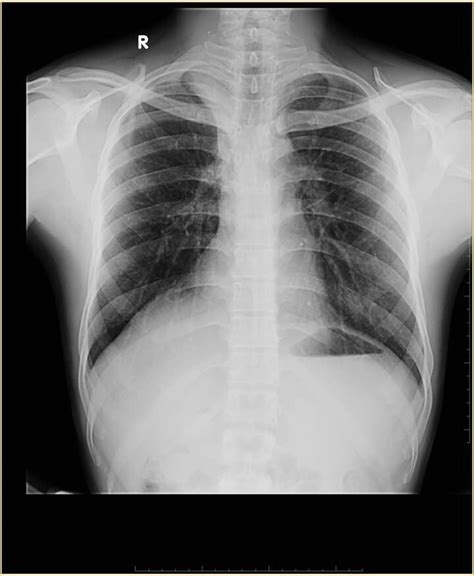 Rt Lower Lobe Collapse Atelectasis Of The Right Lower Lobe Seen On