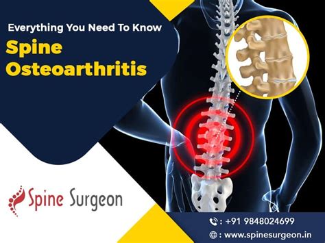 Everything You Need To Know About Spine Osteoarthritis Spine Surgeon