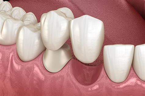 dental bridges replace missing teeth nuffield dental