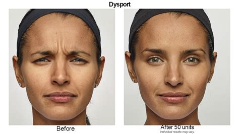 dysport injections in gainesville fl