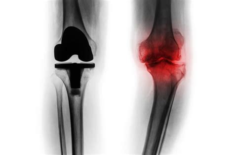 Check spelling or type a new query. advocatingfortheaging.com | Total knee replacement, Knee ...