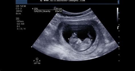Ultrasound Imaging Fetal 3d Ultrasound Images At 10 Weeks
