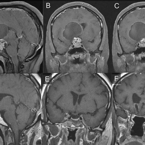 Preoperative Postgadolinium T1 Weighted Mri Sagittal A And Coronal B