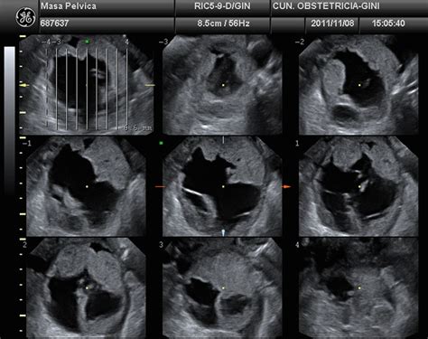 Tomographic Ultrasound Imaging Tui Displays The Lesion In Several
