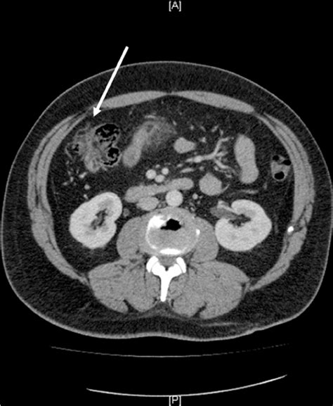 Ct Scan Of The Abdomen And Pelvis Revealed An Abnormal Area Of
