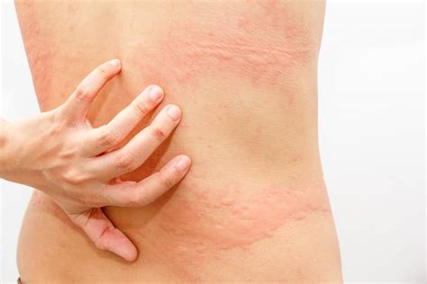 Skin Allergies Pensacola Dermatology