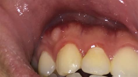 White Bump On Gums Not Painful And Feels Hard Just Appeared Today