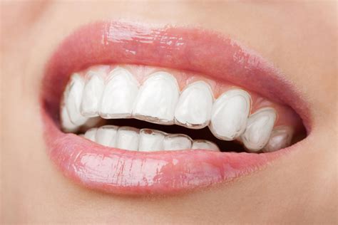 How Much Does Invisalign Cost Dublin Orthodontics