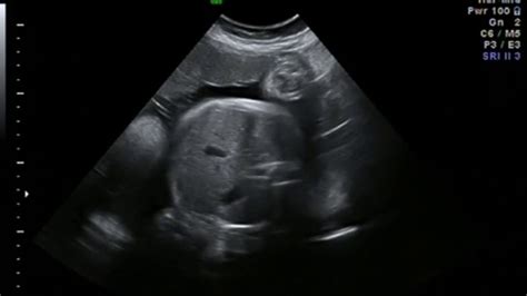 36 Week Baby Ultrasound Scan Youtube