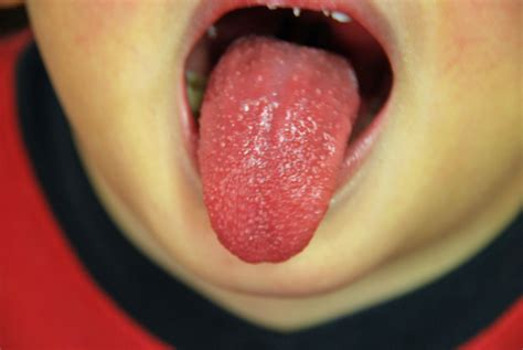 What Your Tongue Can Tell You About Your Health My Health Maven