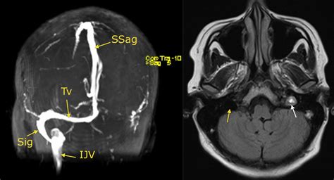 Venous Sinus Thrombosis Radiology At St Vincents University Hospital