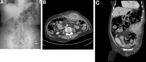 An Unusual Cause Of Anterior Abdominal Wall Abscess Gastroenterology