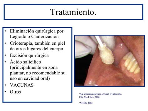 Patologia Oral Infección Papiloma Humano