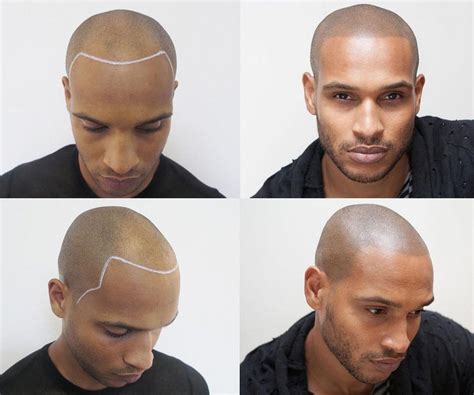 Guys Are Tattooing Hair Onto Their Bald Heads Gq