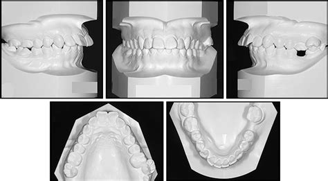 Figure 1 From Orthodontic Uprighting Of A Horizontally Impacted Third