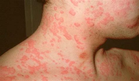 Виды аллергии на коже у взрослых фото и как лечить