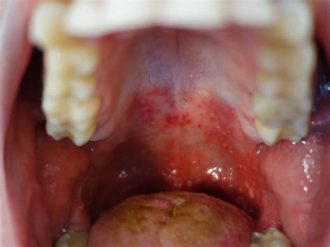 Tiny Bumps On Mouth Roof Red Spots On Roof Of Mouth Itchy Sores Bumps