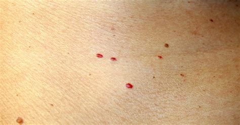 A Quick Way To Get Rid Of Cherry Angiomas Red Moles At Home