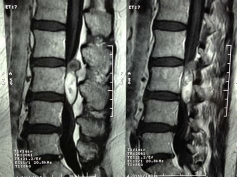 Lecture Synovial Cyst Of The Lumbar Spine 2018 Nov