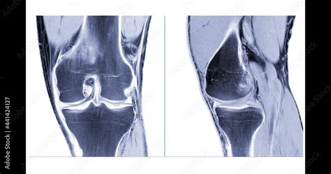 Stockvideo Compare Of Mri Knee Or Magnetic Resonance Imaging Of Knee