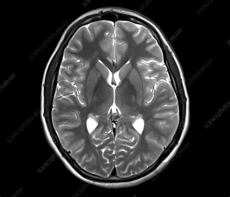 Human Brain Axial Mri Scan Stock Image C0388670 Science Photo
